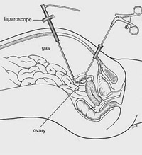 Laparoscopic Surgery